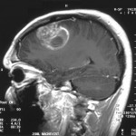 MRI showing a glioblastoma tumor