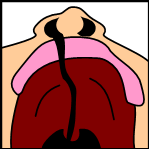 A unilateral cleft palate
