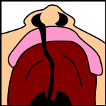 cleftpalate1 A unilateral cleft palate