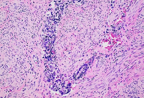 Histopathology of endometrial cancer with lymphovascular invasion