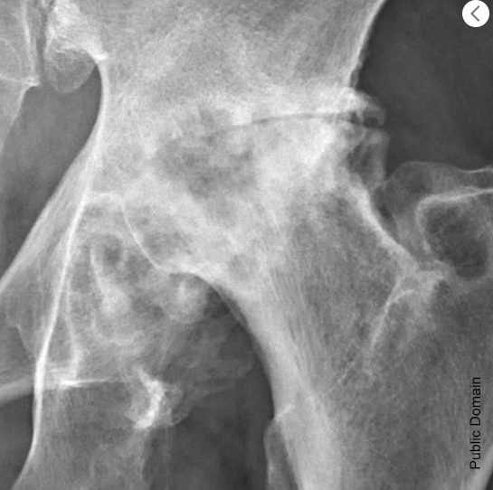 Projectional radiography of the left hip of a 65 year old man with pain upon hip movement. It shows severe (Tönnis grade 3) osteoarthritis