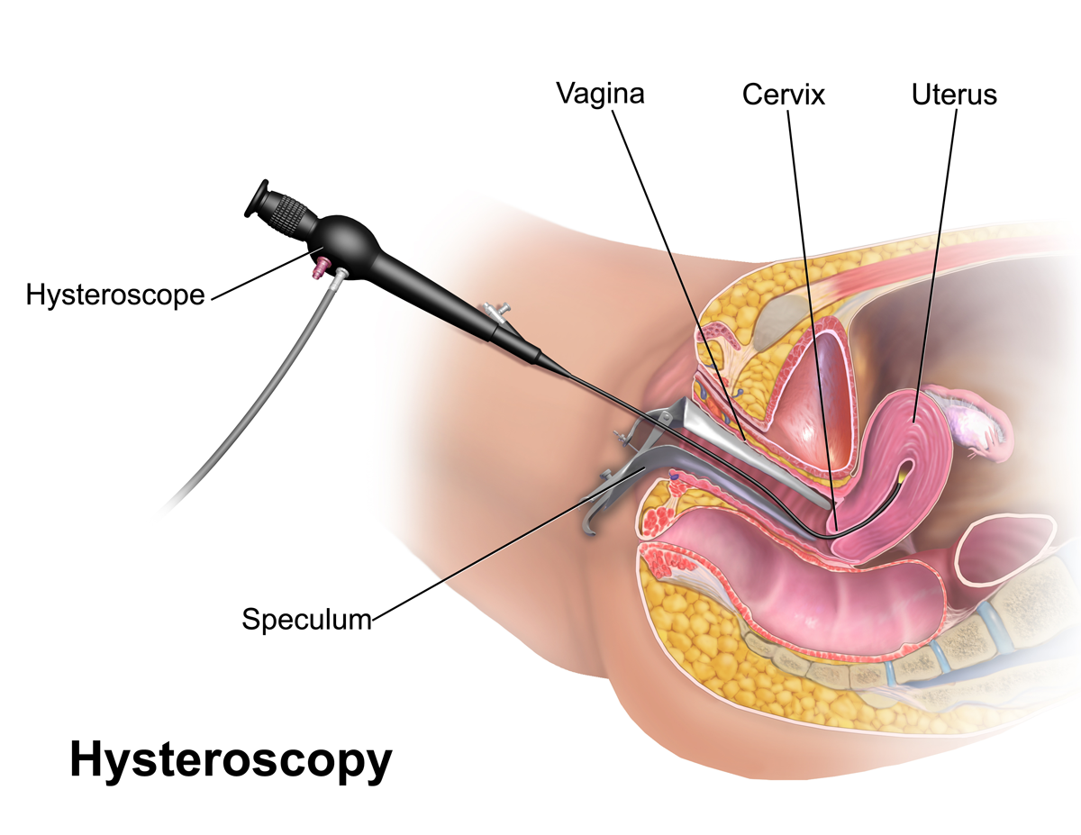 Hysteroscopy. This image was donated by Blausen Medical.