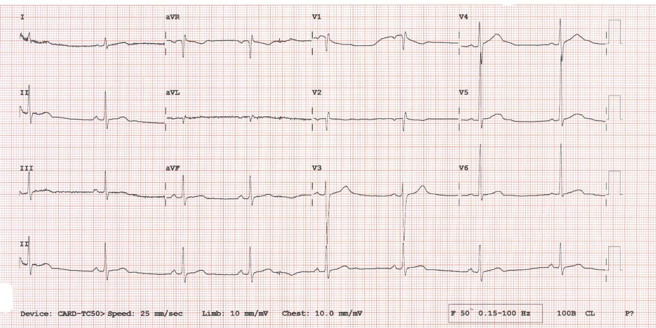 A 12-lead electrocardiogram (ECG) measured in clinical practice.
