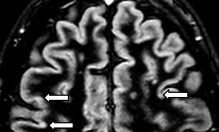 Double inversion recovery (DIR) MRI in the axial plane of the brain, showing lesions by multiple sclerosis.