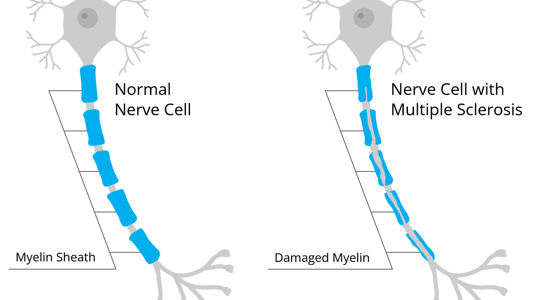 Normal nerve cell with myelinated axon in comparison to a nerve cell with multiple sclerosis and damaged myelin sheath