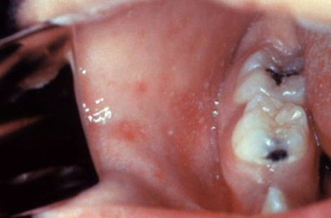 This patient presented on the third pre-eruptive day with “Koplik spots” indicative of the beginning onset of measles. In the prodromal or beginning stages,