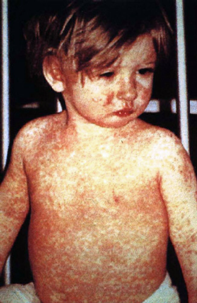 Measles. This child shows a classic day-4 rash with measles.