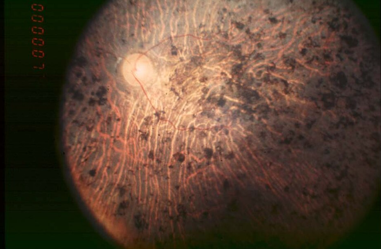 Fundus of patient with retinitis pigmentosa, end stage (Pigment deposits are present all over the retina. Retinal vessels are very thin and optic disc is pale.) Hamel Orphanet Journal of Rare Diseases 2006