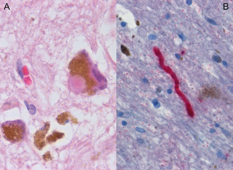 Histological sample of Substantia nigra in Parkinson's disease