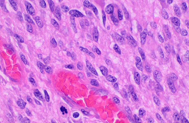 Histopathology of glioblastoma, high magnification