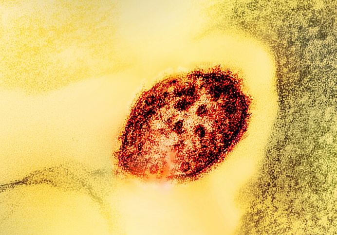 Colorized transmission electron micrograph of a measles virus particle (red). Credit: microscopy by CDC; layout, colorization and visual effects by NIAID.